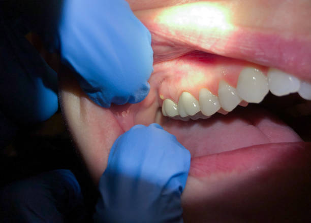 Best Emergency Root Canal Treatment in Trevose, PA